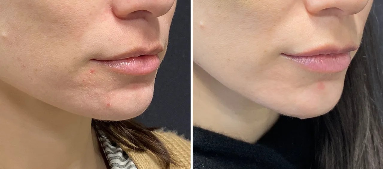 Skin texture refinement before and after — chin and jawline